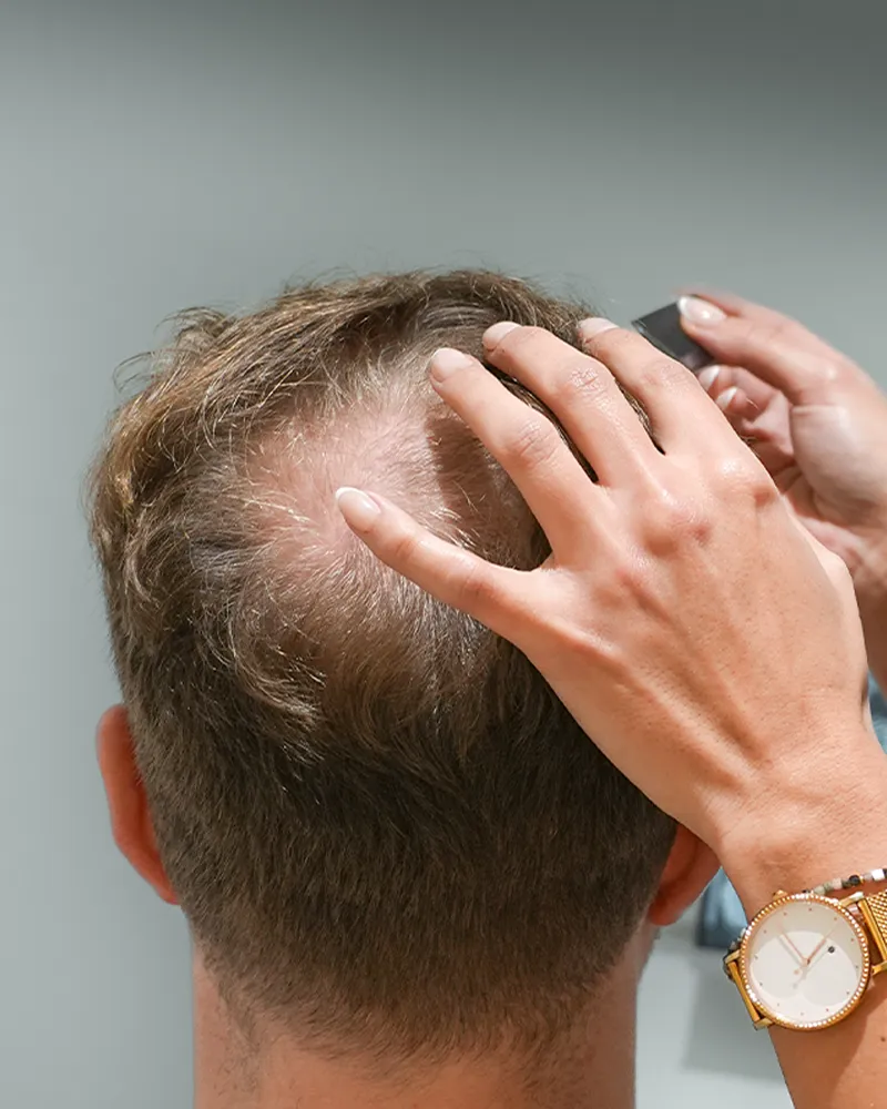 I'm considering a hair transplant